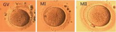 未成熟卵体外成熟培养(IVM)