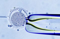第二代试管婴儿(ICSI)卵细胞浆内单精子显微注射