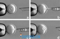 第四代试管婴儿 (Cytoplasm Transfer)